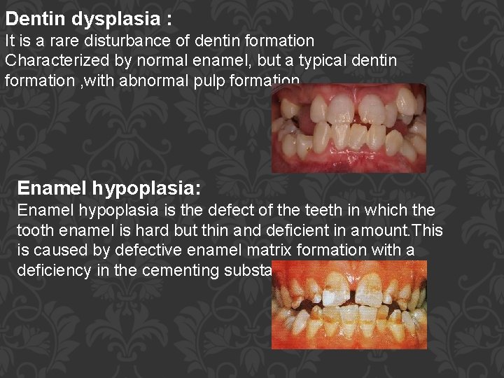 Dentin dysplasia : It is a rare disturbance of dentin formation Characterized by normal