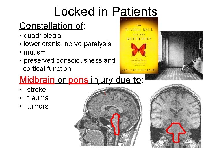 Locked in Patients Constellation of: • quadriplegia • lower cranial nerve paralysis • mutism