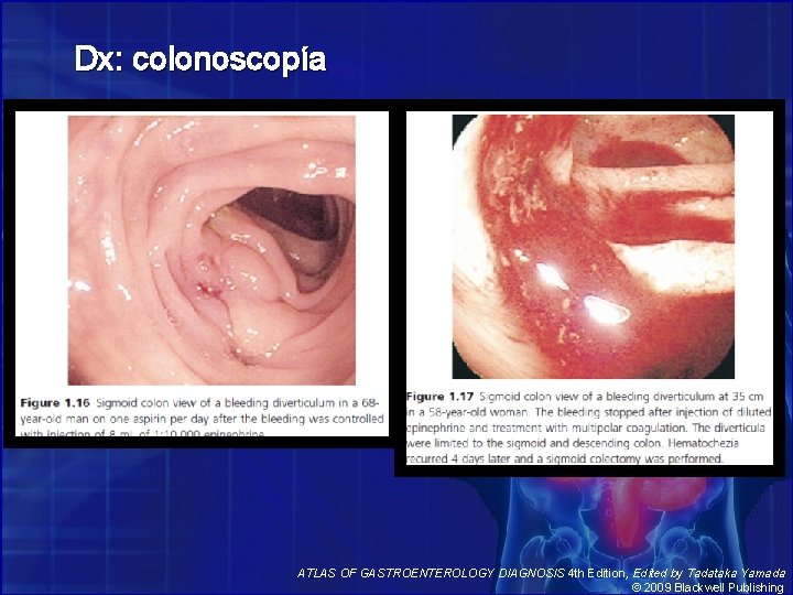 Dx: colonoscopía ATLAS OF GASTROENTEROLOGY DIAGNOSIS 4 th Edition, Edited by Tadataka Yamada ©