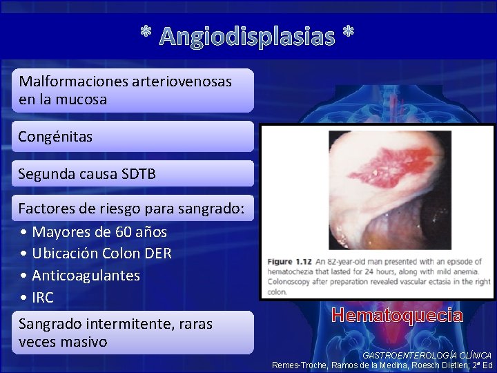 * Angiodisplasias * Malformaciones arteriovenosas en la mucosa Congénitas Segunda causa SDTB Factores de