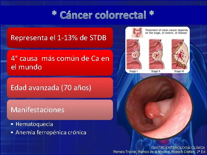 * Cáncer colorrectal * Representa el 1 -13% de STDB 4° causa más común