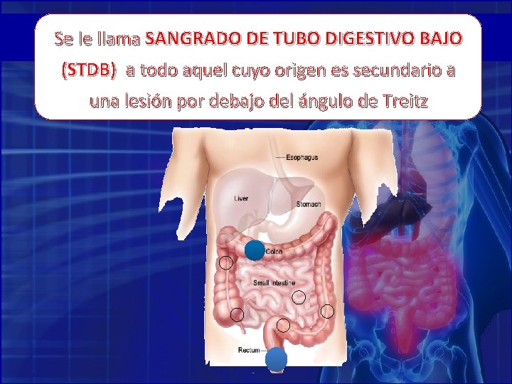 Se le llama SANGRADO DE TUBO DIGESTIVO BAJO (STDB) a todo aquel cuyo origen