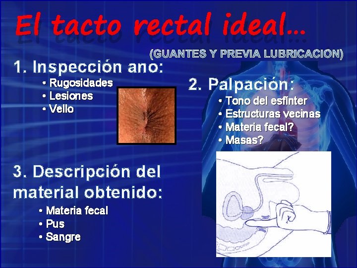 El tacto rectal ideal… (GUANTES Y PREVIA LUBRICACIÓN) 1. Inspección ano: • Rugosidades •
