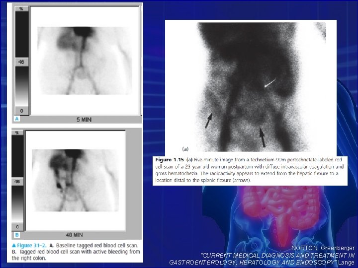 NORTON, Greenberger “CURRENT MEDICAL DIAGNOSIS AND TREATMENT IN GASTROENTEROLOGY, HEPATOLOGY AND ENDOSCOPY” Lange 