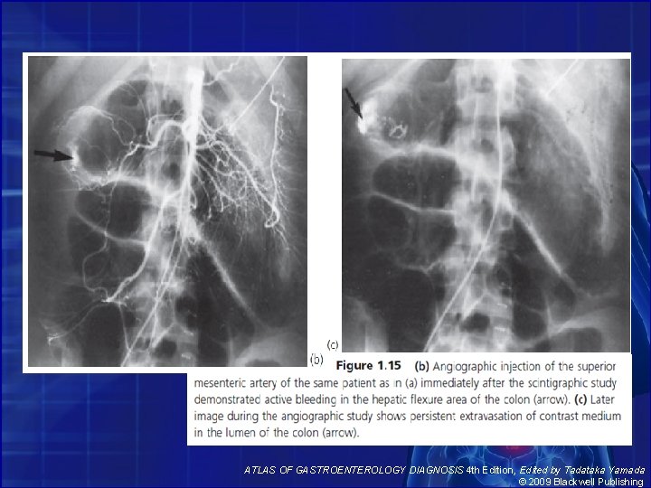 ATLAS OF GASTROENTEROLOGY DIAGNOSIS 4 th Edition, Edited by Tadataka Yamada © 2009 Blackwell