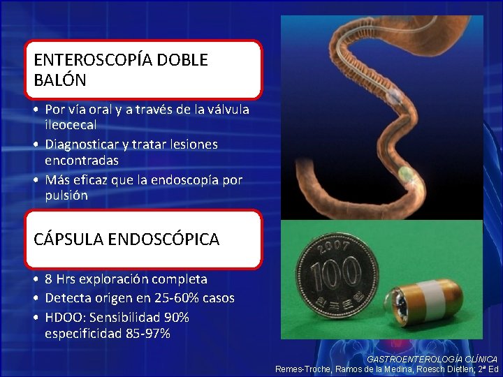 ENTEROSCOPÍA DOBLE BALÓN • Por vía oral y a través de la válvula ileocecal