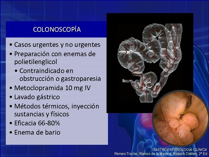 COLONOSCOPÍA • Casos urgentes y no urgentes • Preparación con enemas de polietilenglicol •