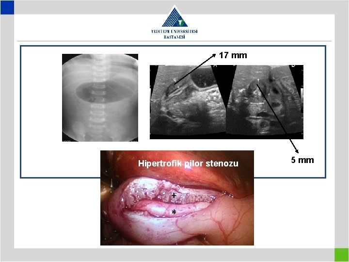 17 mm Hipertrofik pilor stenozu 5 mm 
