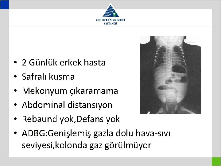  • • • 2 Günlük erkek hasta Safralı kusma Mekonyum çıkaramama Abdominal distansiyon