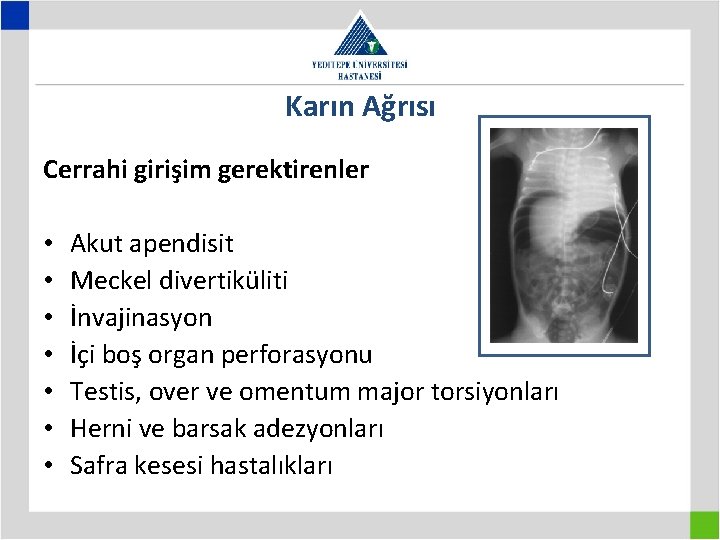 Karın Ağrısı Cerrahi girişim gerektirenler • • Akut apendisit Meckel divertiküliti İnvajinasyon İçi boş