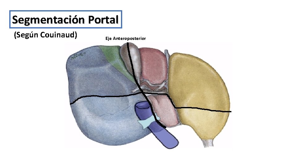 Segmentación Portal (Según Couinaud) Eje Anteroposterior 