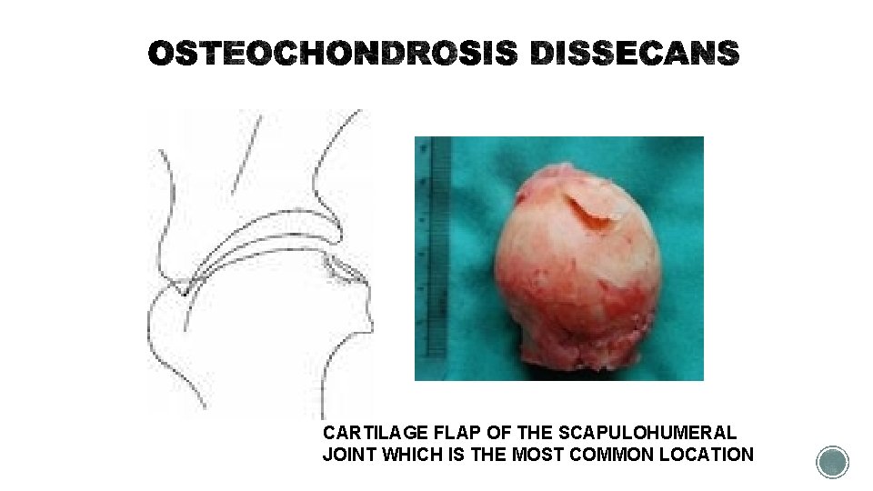 CARTILAGE FLAP OF THE SCAPULOHUMERAL JOINT WHICH IS THE MOST COMMON LOCATION 