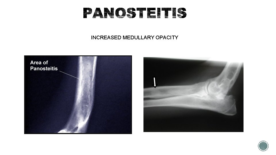 INCREASED MEDULLARY OPACITY 