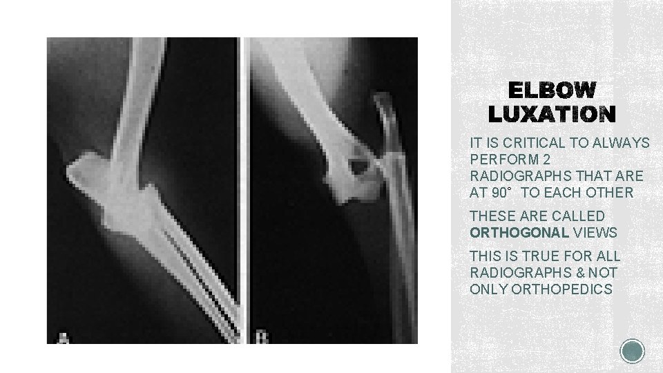 IT IS CRITICAL TO ALWAYS PERFORM 2 RADIOGRAPHS THAT ARE AT 90∘TO EACH OTHER