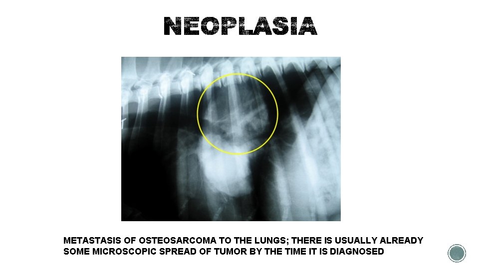 METASTASIS OF OSTEOSARCOMA TO THE LUNGS; THERE IS USUALLY ALREADY SOME MICROSCOPIC SPREAD OF