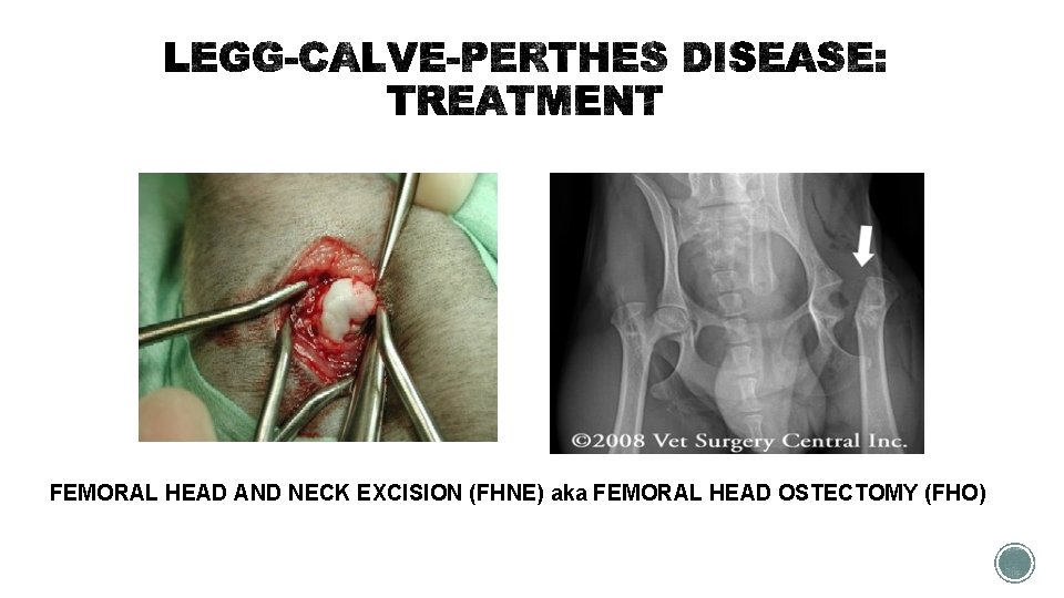 FEMORAL HEAD AND NECK EXCISION (FHNE) aka FEMORAL HEAD OSTECTOMY (FHO) 