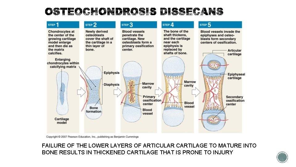 FAILURE OF THE LOWER LAYERS OF ARTICULAR CARTILAGE TO MATURE INTO BONE RESULTS IN