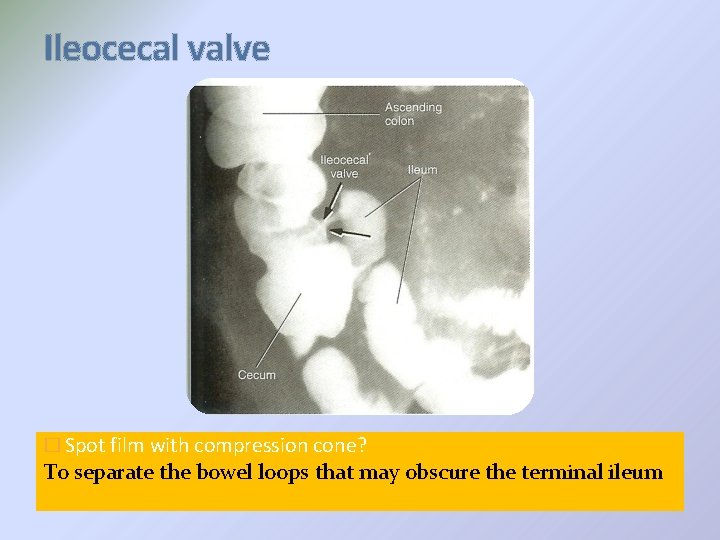 Ileocecal valve � Spot film with compression cone? To separate the bowel loops that