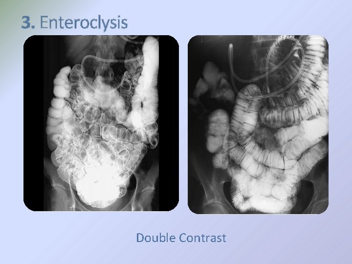 3. Enteroclysis Double Contrast 