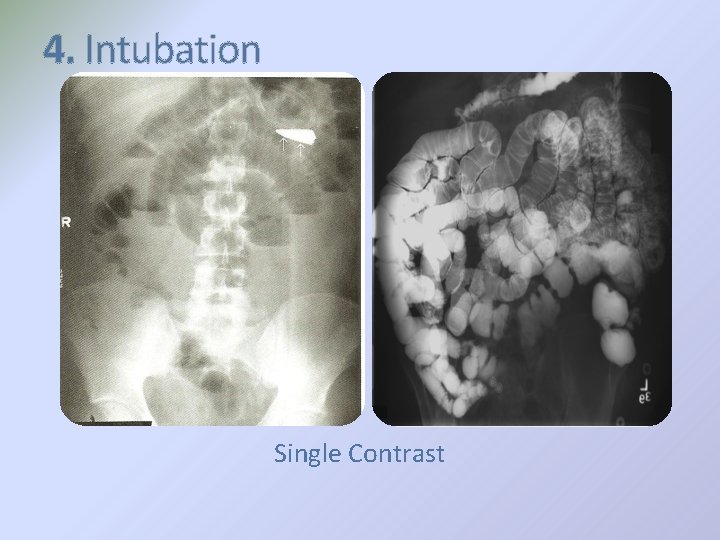 4. Intubation Single Contrast 