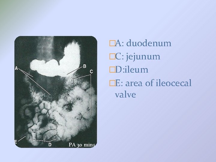�A: duodenum �C: jejunum �D: ileum �E: area of ileocecal valve PA 30 mins
