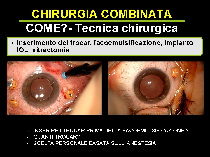 CHIRURGIA COMBINATA COME? - Tecnica chirurgica • Inserimento dei trocar, facoemulsificazione, impianto IOL, vitrectomia