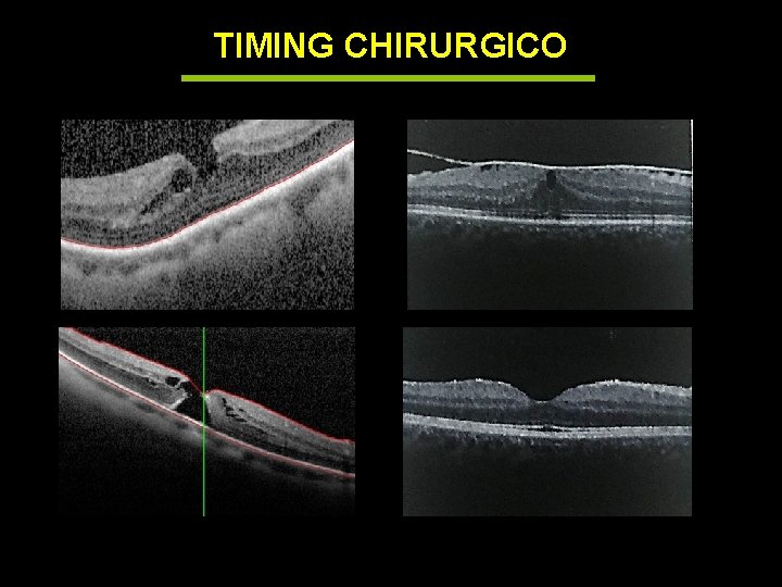 TIMING CHIRURGICO 