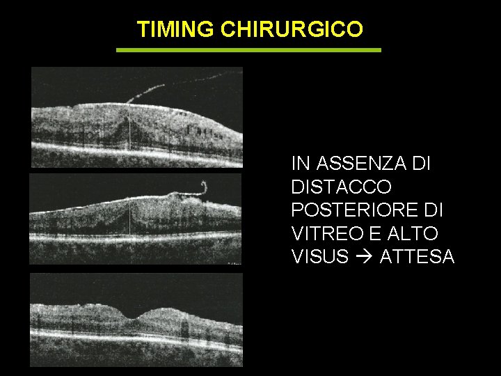 TIMING CHIRURGICO IN ASSENZA DI DISTACCO POSTERIORE DI VITREO E ALTO VISUS ATTESA 