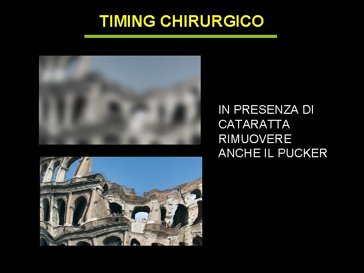 TIMING CHIRURGICO IN PRESENZA DI CATARATTA RIMUOVERE ANCHE IL PUCKER 