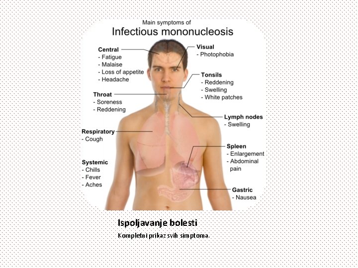 Ispoljavanje bolesti Kompletni prikaz svih simptoma. 