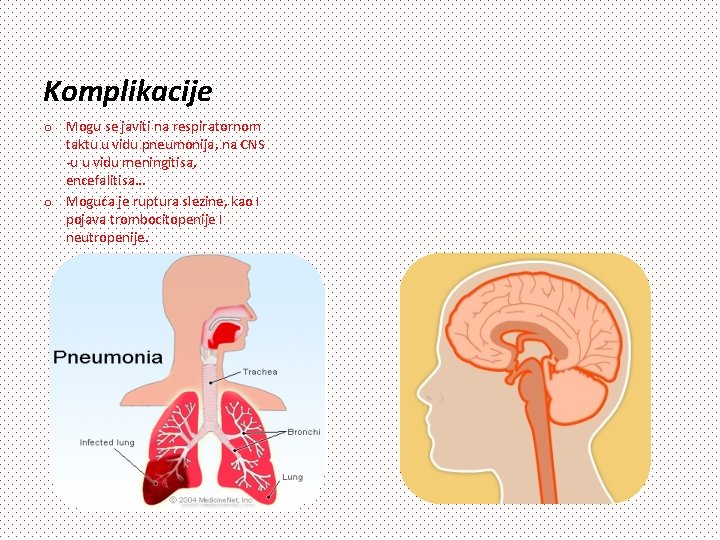 Komplikacije o Mogu se javiti na respiratornom taktu u vidu pneumonija, na CNS -u