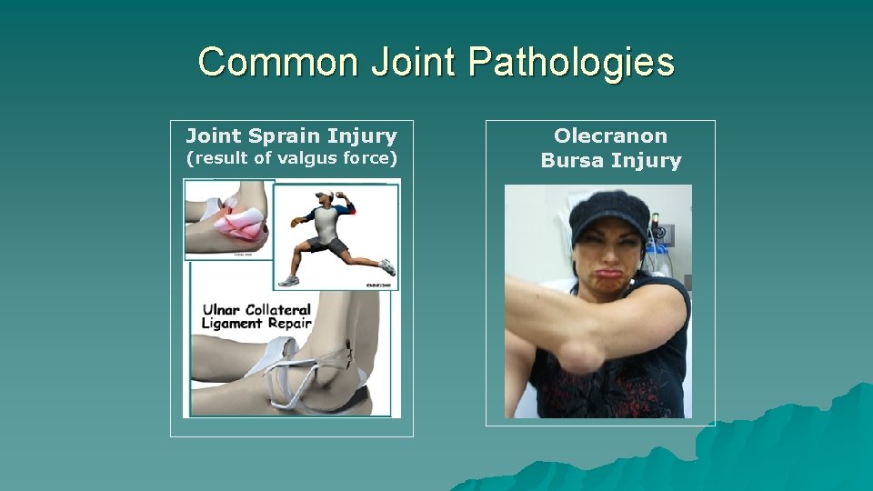 Common Joint Pathologies Joint Sprain Injury (result of valgus force) Olecranon Bursa Injury Common Joint Pathologies Joint Sprain Injury (result of valgus force) Olecranon Bursa Injury