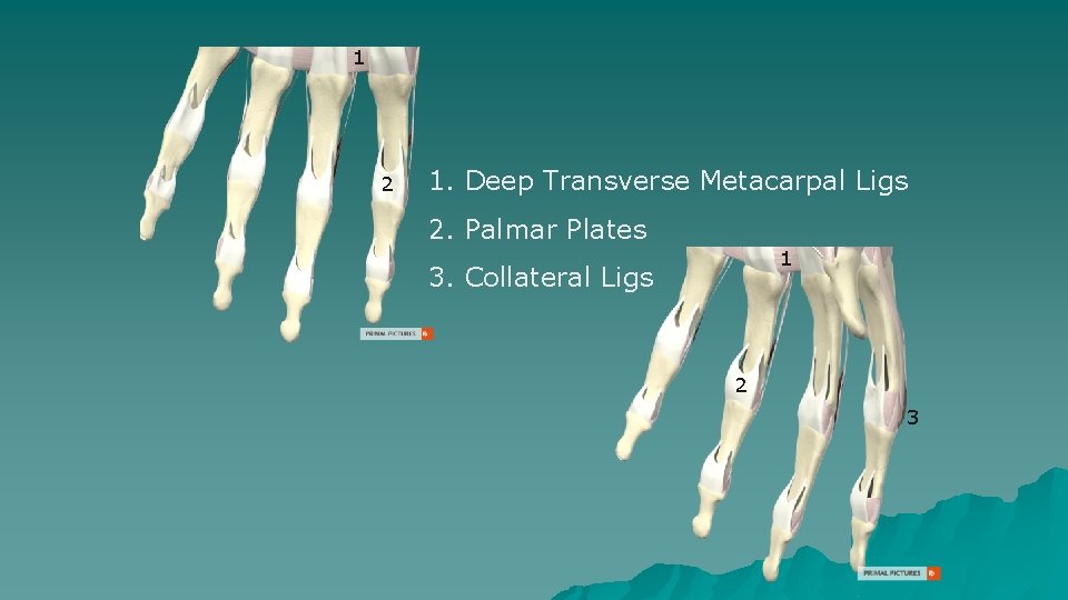 1 2 1. Deep Transverse Metacarpal Ligs 2. Palmar Plates 1 3. Collateral Ligs 1 2 1. Deep Transverse Metacarpal Ligs 2. Palmar Plates 1 3. Collateral Ligs