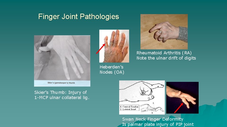 Finger Joint Pathologies Rheumatoid Arthritis (RA) Note the ulnar drift of digits Heberden’s Nodes Finger Joint Pathologies Rheumatoid Arthritis (RA) Note the ulnar drift of digits Heberden’s Nodes
