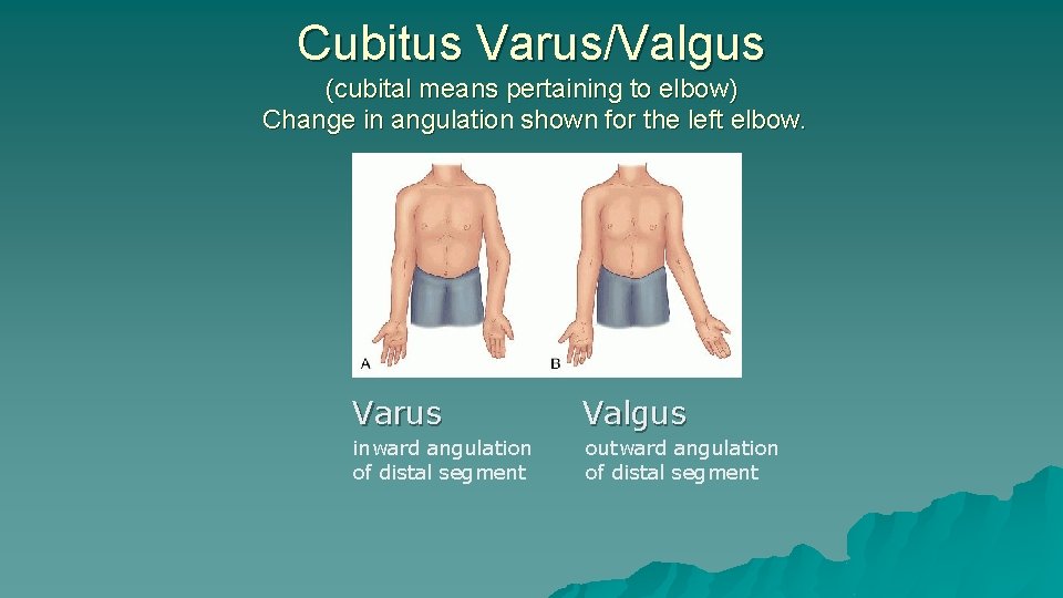 Cubitus Varus/Valgus (cubital means pertaining to elbow) Change in angulation shown for the left Cubitus Varus/Valgus (cubital means pertaining to elbow) Change in angulation shown for the left