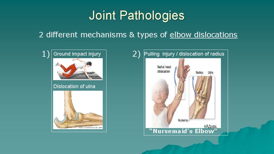 Joint Pathologies 2 different mechanisms & types of elbow dislocations 1) Ground impact injury Joint Pathologies 2 different mechanisms & types of elbow dislocations 1) Ground impact injury