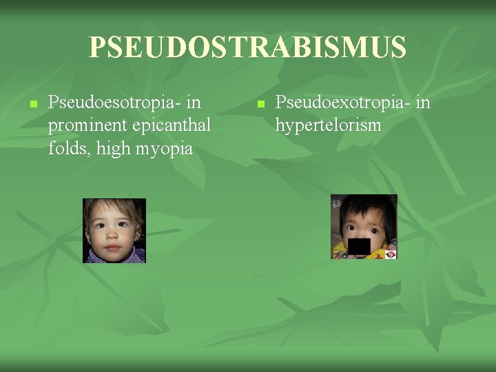 PSEUDOSTRABISMUS n Pseudoesotropia- in prominent epicanthal folds, high myopia n Pseudoexotropia- in hypertelorism 