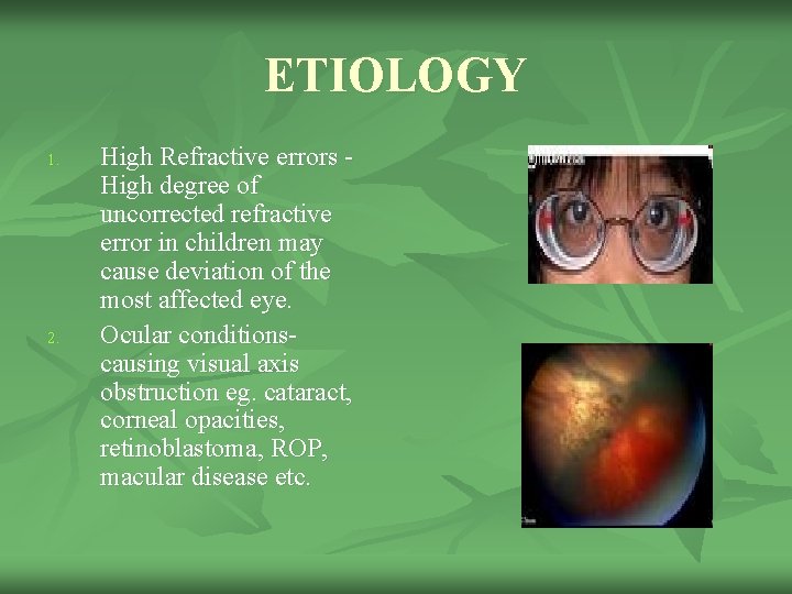 ETIOLOGY 1. 2. High Refractive errors High degree of uncorrected refractive error in children