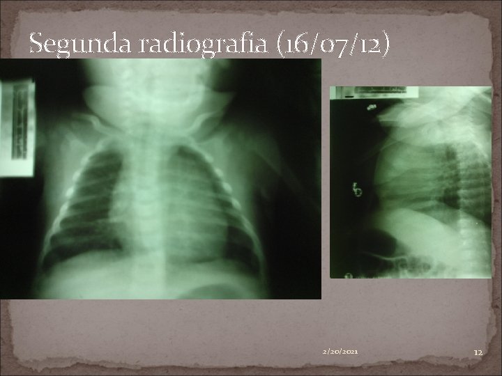 Segunda radiografia (16/07/12) 2/20/2021 12 