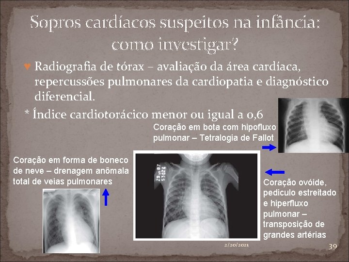 Sopros cardíacos suspeitos na infância: como investigar? ♥ Radiografia de tórax – avaliação da