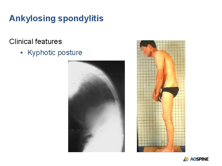 Ankylosing spondylitis Clinical features • Kyphotic posture 