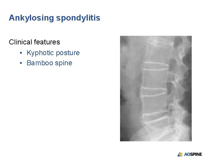 Ankylosing spondylitis Clinical features • Kyphotic posture • Bamboo spine 