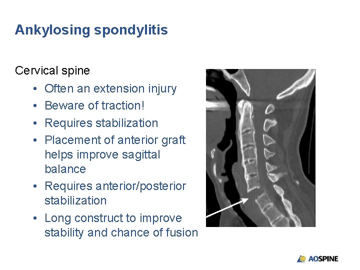 Ankylosing spondylitis Cervical spine • Often an extension injury • Beware of traction! •
