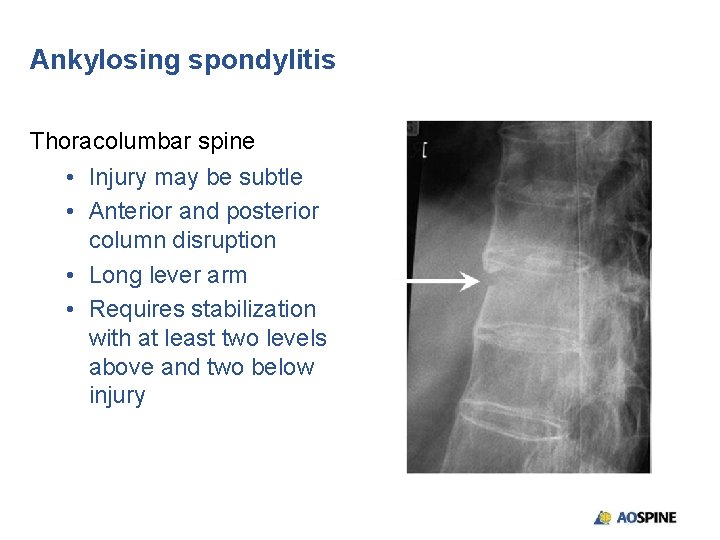 Ankylosing spondylitis Thoracolumbar spine • Injury may be subtle • Anterior and posterior column