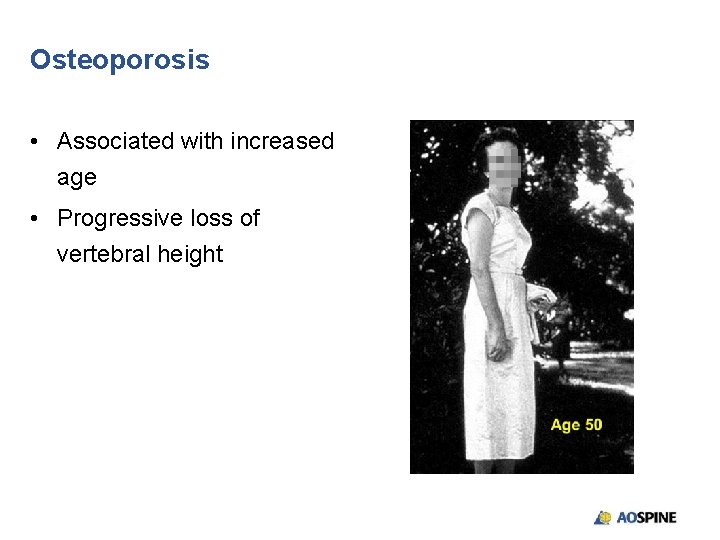 Osteoporosis • Associated with increased age • Progressive loss of vertebral height 