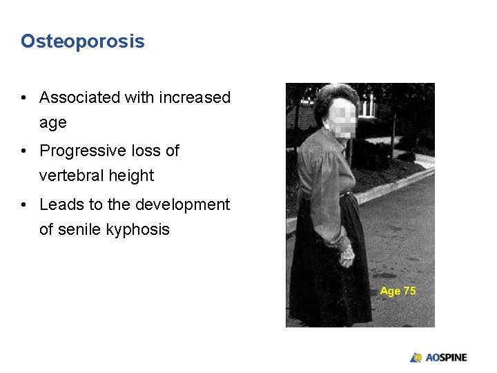 Osteoporosis • Associated with increased age • Progressive loss of vertebral height • Leads