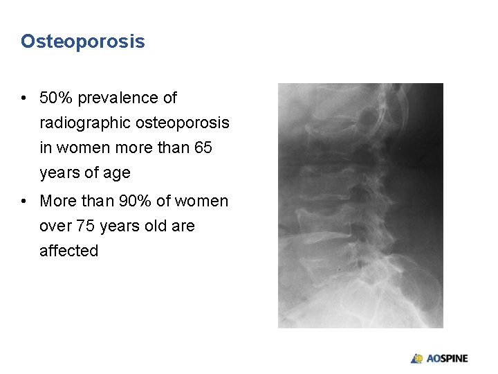 Osteoporosis • 50% prevalence of radiographic osteoporosis in women more than 65 years of