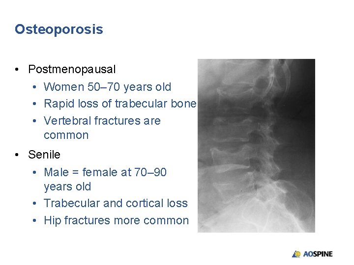 Osteoporosis • Postmenopausal • Women 50– 70 years old • Rapid loss of trabecular