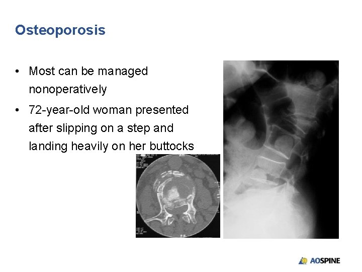 Osteoporosis • Most can be managed nonoperatively • 72 -year-old woman presented after slipping