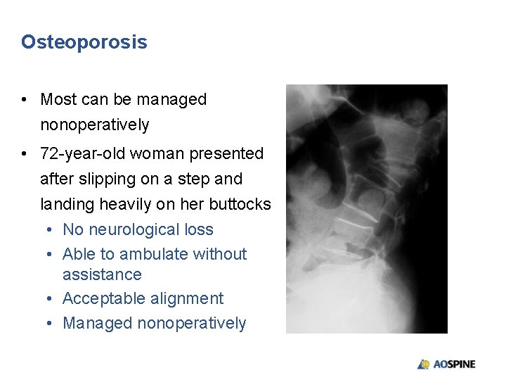 Osteoporosis • Most can be managed nonoperatively • 72 -year-old woman presented after slipping